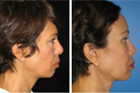 Before & After Photos